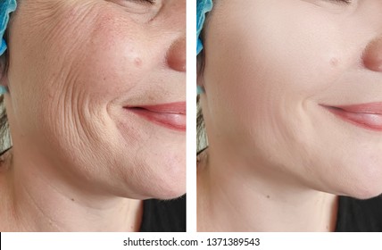 Woman Wrinkles   After Procedures