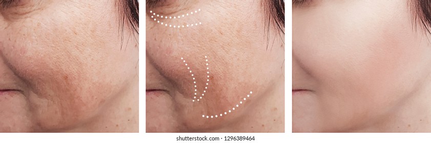 Woman Wrinkles Before After Procedures Stock Photo Edit Now