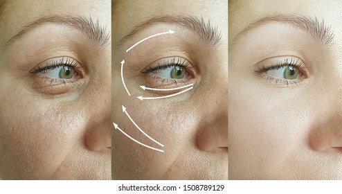 Woman Face Wrinkles Before After Treatment Stock Photo (Edit Now ...