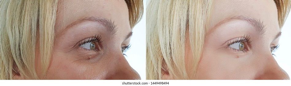 woman wrinkles face   after treatment 