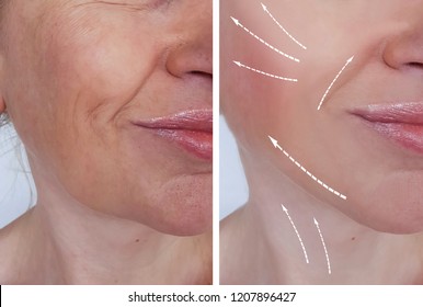 Cheek Fillers Images Stock Photos Vectors Shutterstock