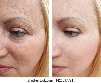 Woman Wrinkles Face Before After Procedures Stock Photo 1425337721