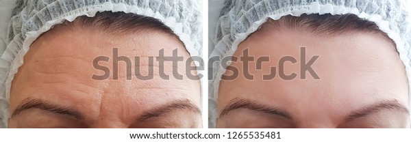 Woman\
wrinkles forehead before and after\
procedures