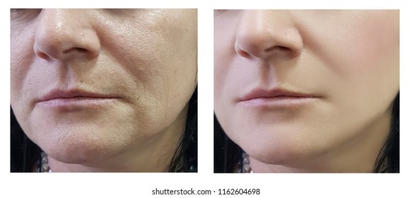 woman wrinkles on face before and after cosmetic procedures