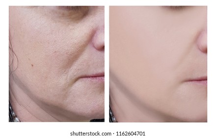 woman wrinkles on face before and after cosmetic procedures - Shutterstock ID 1162604701