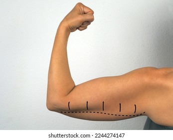 A woman's arm shows excess fat in the triceps area. Indication of the problem area on the shoulder for liposuction or plastic surgery. - Shutterstock ID 2244274147