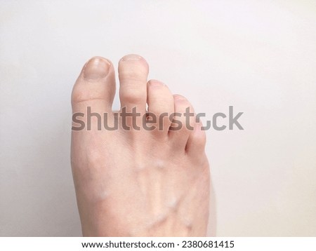 A woman's bare foot with claw toes.