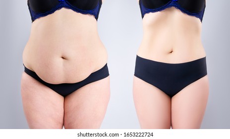 Woman's belly before and after weight loss on gray background, plastic surgery concept - Shutterstock ID 1653222724