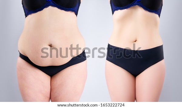 Woman\'s belly before and after weight\
loss on gray background, plastic surgery\
concept