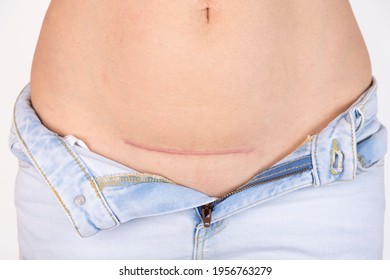 Woman's belly with a scar after cesarean section, childbirth. Five months after surgery.