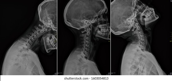 Woman's black and white cervical x-ray.
