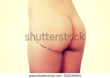 Woman's buttock prepared to plastic surgery.