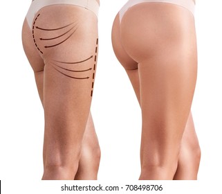 Woman's buttocks before and after plastic surgery - Shutterstock ID 708498706