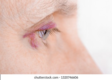 hematoma versus equimosis