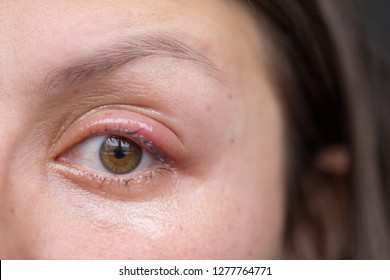 Woman's Eye With Sty.