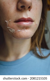 Woman's Face After Chemical Peeling. Peeling Skin On The Face. Exfoliation Of Old Skin Problems, Acne, Blackheads.