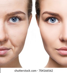 Woman's face before and after rejuvenation.