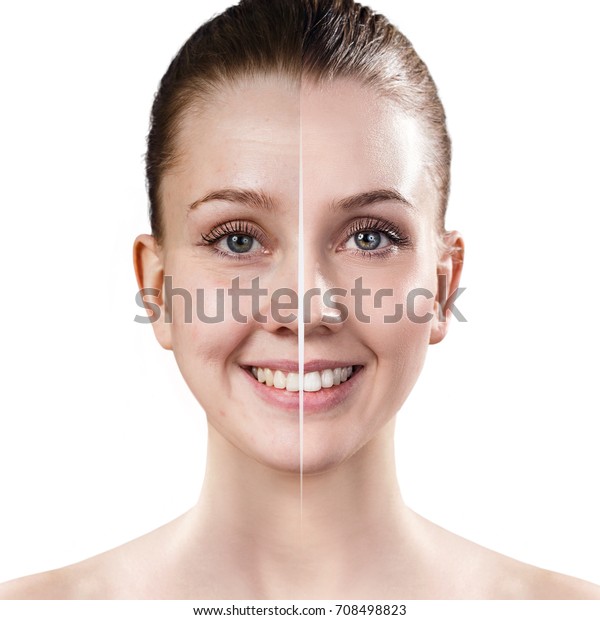 burn victims face before and after burn victims face before and after