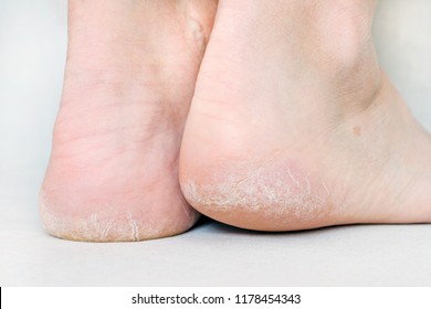 Womans Feet With Dry Heels, Cracked Skin