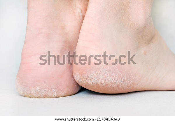 womans feet with dry\
heels, cracked skin