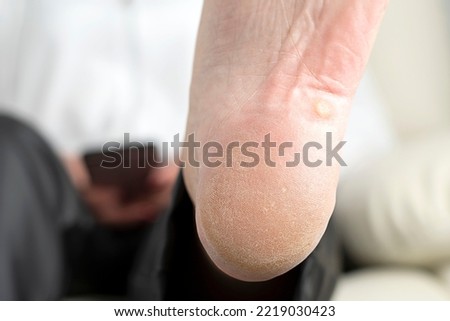 Woman's foot with cracks and rough skin on the heels. Corns and growths. Hardware pedicure. Close-up. Soft focus. Health concept.