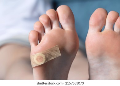 Woman's Foot With Glued Medical Plaster For Plantar Wart. Treatment Of Calluses And Warts On The Feet, Dermatological