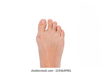 A Woman's Foot With Hallux Valgus Deformity Of The Big Toe Caused By Wearing Uncomfortable Shoes Isolated On A White Background. Orthodontics