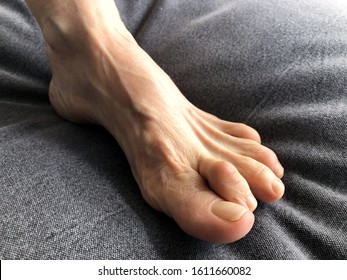 Woman's Foot With Hammer Toe. 