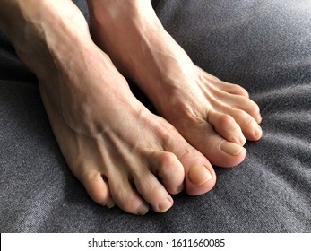 Woman's foot with hammer toe.  - Shutterstock ID 1611660085