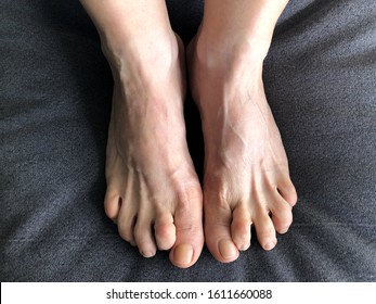 Woman's Foot With Hammer Toe. 