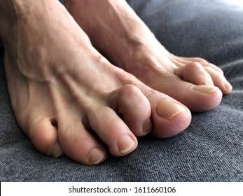 Woman's foot with hammer toe. 