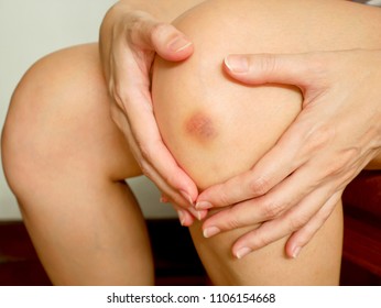 Woman's Got A Purple Bruise On Her Khee