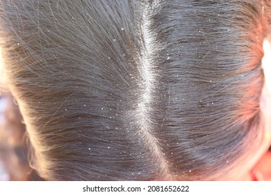 Woman's Hair Top View Close-up And Selective Focus With Dandruff, Hair Problem Concept