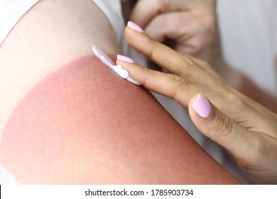 Woman's Hand Applies Cream To Burn To Treat Sunburn. Consequences Of Sunburn And Their Treatment Concept