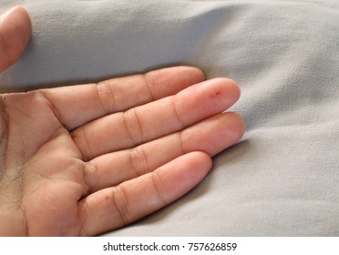 Woman's Hand  With A Bite Wound From Centipede.