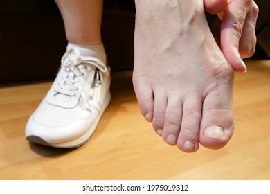 Woman's Hand Massaging Her Bunion Toes In Bare Feet To Relieve Pain. Woman Leg In White Sneakers. Woman Feet Problem. Hallux Valgus. Closeup