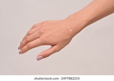 A woman's hand with a scar after surgery. on a white background. a scar on his arm from hygroma.