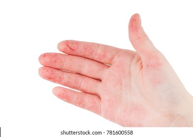 Palm with wound Images, Stock Photos & Vectors | Shutterstock