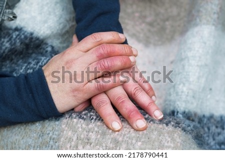Woman's hands with wounds from Raynaud's syndrome. circulatory problems.