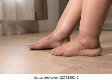 Woman's leg is edema (swelling) after cancer treatment. - Shutterstock ID 2278258243