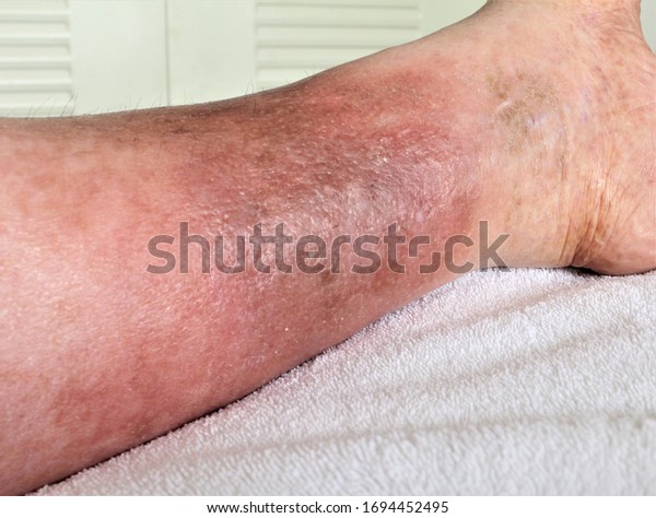 Womans Leg Shown She Suffering Chronic Stock Photo 1694452495 ...