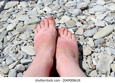 A Woman's Leg Stands On A Pebble Beach. Red Tanned Feet. Sunburn.