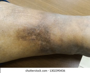 A Woman's Leg Swollen With Bacterial Skin Infection Called: Erysipelas Disease Is A Bacterium In The Upper Layer Of The Skin. Penicillin Antibiotics Treat Erysipelas.