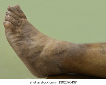 A Woman's Leg Swollen With Bacterial Skin Infection Called: Erysipelas Disease Is A Bacterium In The Upper Layer Of The Skin. Penicillin Antibiotics Treat Erysipelas.