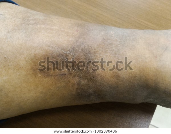 A woman\'s leg\
swollen with bacterial skin infection called: erysipelas disease is\
a bacterium in the upper layer of the skin. Penicillin antibiotics\
treat erysipelas.