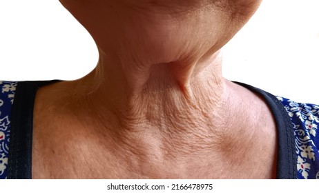 A Woman's Neck Has Wrinkles.