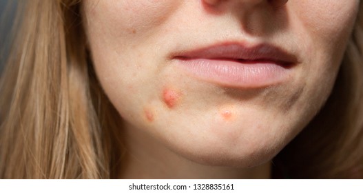 Womans Oily Skin Acne Problems Scars Stock Photo (Edit Now) 1328835161