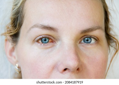 The woman's right eye is sick with keratitis. The fibrous tunic of eyeball is red. The eye is watery. Closeup. Portrait of young woman