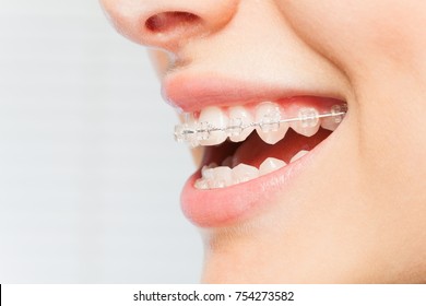 Woman's Smile With Clear Dental Braces On Teeth