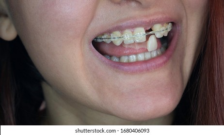 A Woman's Smile. Smile Without Upper Left Unit Teeth. Tooth Model With Metal Wire Dental Brace. Single Missing Tooth - Removable Partial Denture. One False Plastic Tooth. 